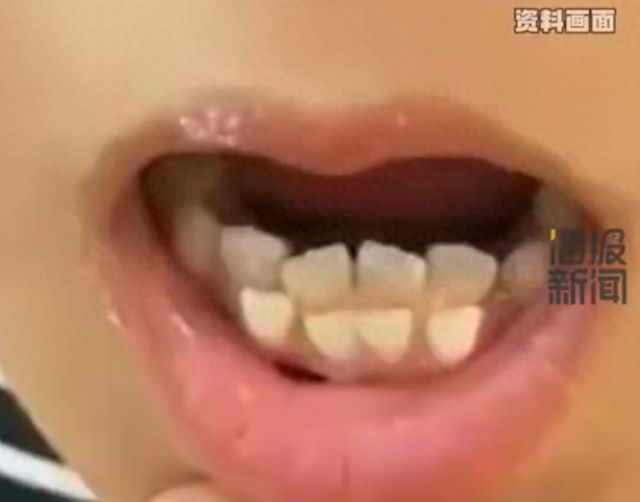 长出双排牙妈妈：吃坚果都要研磨成粉尊龙凯时app6岁女童吃得太精细(图1)